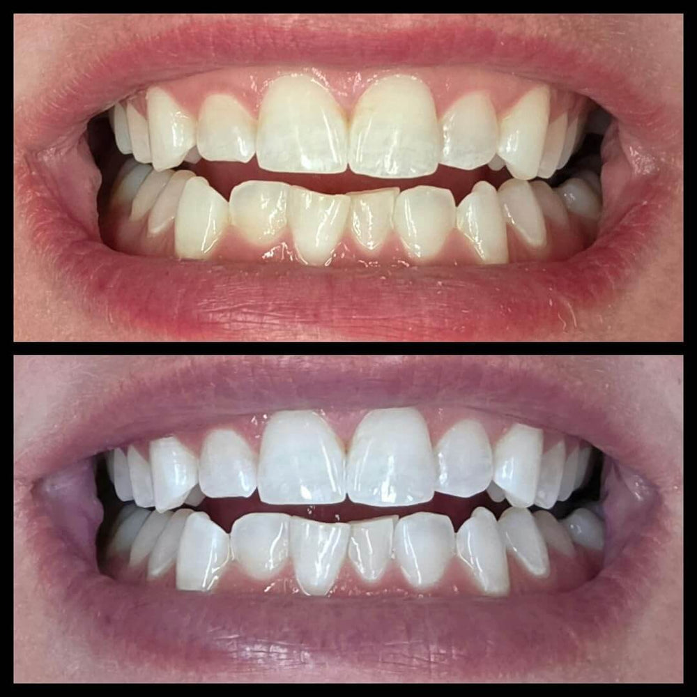 <h2>20,000+ Brighter Smiles</h2>
