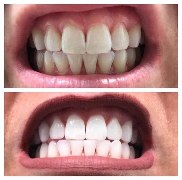 <h2>20,000+ Brighter Smiles</h2>
