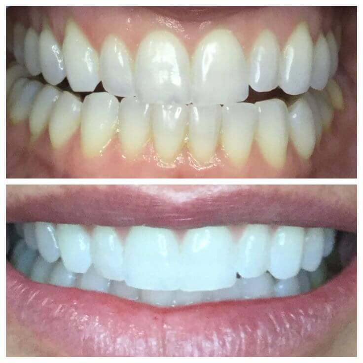 <h2>20,000+ Brighter Smiles</h2>