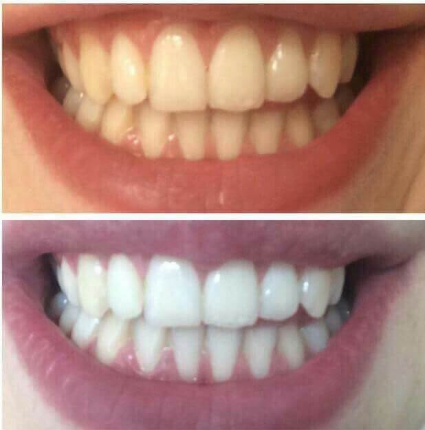 <h2>20,000+ Brighter Smiles</h2>